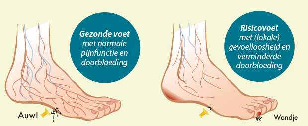 illustratie diabetische voet
