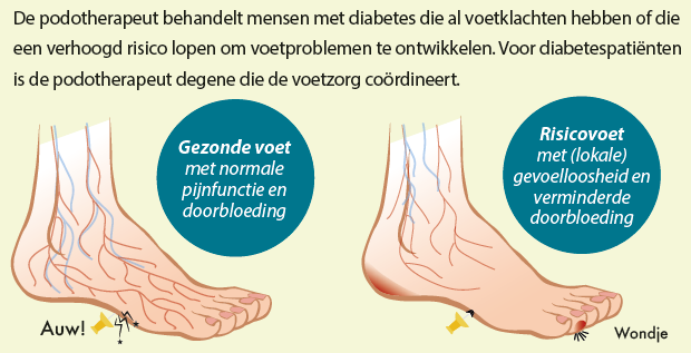 illustratie diabetische voet